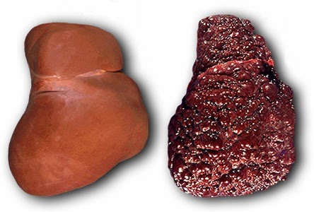 Naam: Lever-gezond-cirrhosis.jpg
Bekeken: 227
Grootte: 37,8 KB