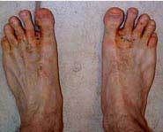 Naam: a230i1_badfeetweb.jpg
Bekeken: 138
Grootte: 5,1 KB